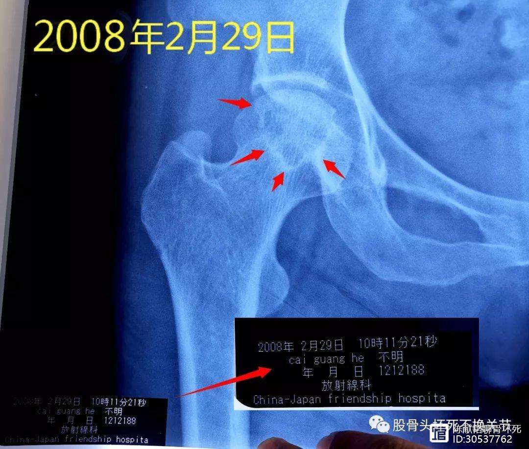 天津人工骨头医保报销多少(人工骨头医保报销多少比例)